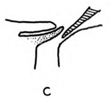 Manner of pushing the valvefold aside and inserting the syringe 2