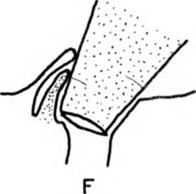 Manner of pushing the valvefold aside and inserting the syringe. (Redrawn from Laidlaw and Eckert, 1962, by permission of The Regents of the University of California. )