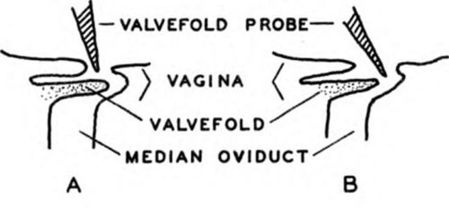 Manner of pushing the valvefold aside and inserting the syringe 1