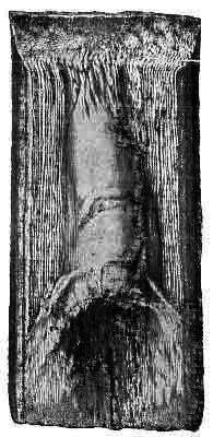 Fig. 132. A Portion Of The Horn Of The Wall At The Toe Removed In Order To Show A Keraphyllocele On Its Inner Surface