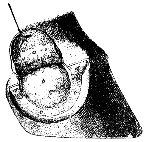Fig. 141. Excision Of The Lateral Cartilage