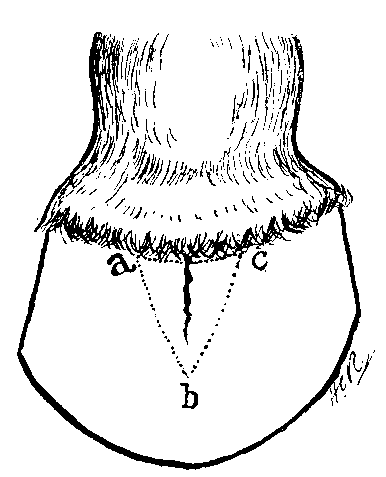 Fig. 97. The Dotted Lines Outline The V Shaped Portion Of Wall To Be Removed In The Treatment Of Complicated Toe Crack
