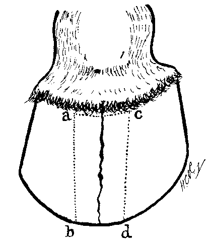 Fig. 98. The dotted lines indicate the portion of wall to be removed in the complete operation for complicated toe crack