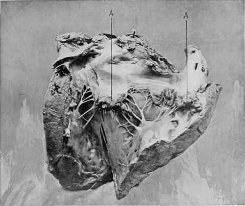 A, A. Valves of the Heart much thickened as the result of Valvular Disease.