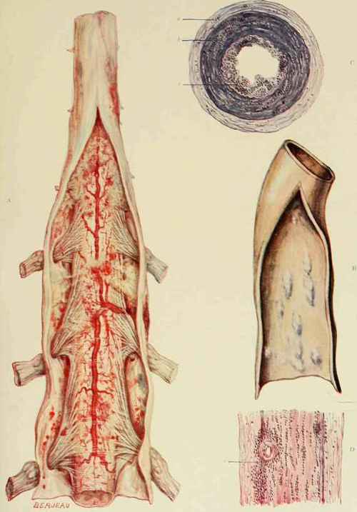 A. Portion of spinal con! showing engorgement of vessels and hemorrhagic points and patches in cerebro spinal meningitis.
