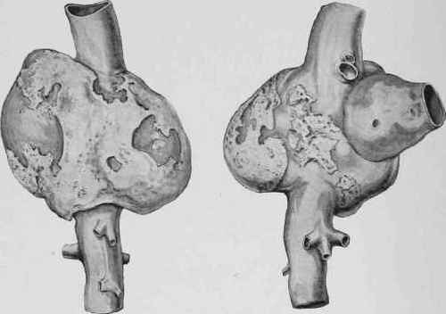 Aneurism of the Aorta.