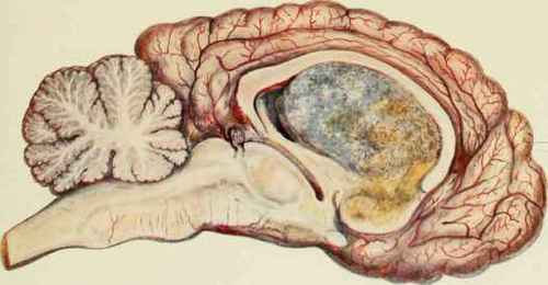 BRAIN TUMOUR.