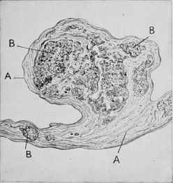 Calcareous degeneration of the mitral valve.