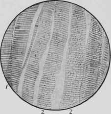 Fatty Degeneration of Muscle.
