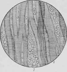 Fatty Infiltration of Muscle.