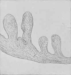 Fibrous vegetation of the mitral valve.