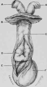 Inguinal Hernia.