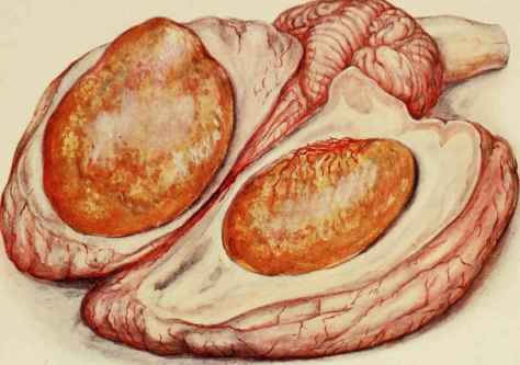 OEDEMA OF CHOROID PLEXUS.