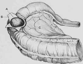 Portion of Intestine impacted with Concretion.