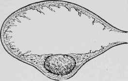 Stone Overgrown with Granulation Tissue.