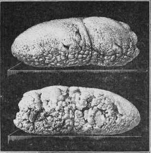 Two Views of a Salivary Calculus. This calculus measured four inches in length.