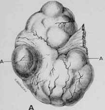 Cystic Disease Of The Ovary 40042
