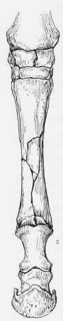Fractures 1, Simple. 2, Comminuted.