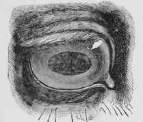 Pupil Dilated.
