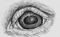 Recurrent Ophthalmia.