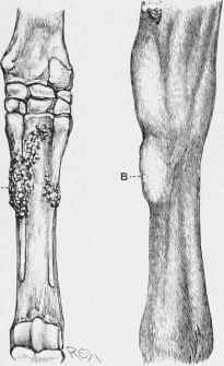 Splint A, Exposed Splint. B, Splint covered by Skin.