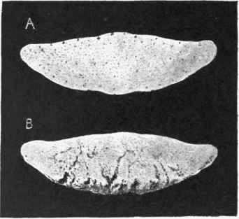Fig . 403.   Sections of Navicular Bone, healthy and diseased.