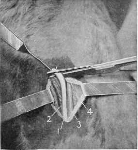 Median Neurectomy.