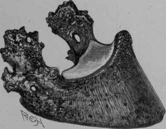 Pedal Bone, showing ossification of ligaments constituting side bones.