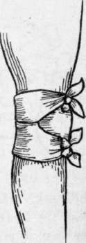 Four Tailed Band age of the Knee Scultetus