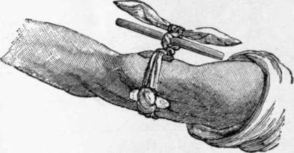 Manner of compressing an artery with a handkerchief and stick