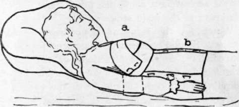 Y Breast Binder (a) And Abdominal Binder (b) In Place