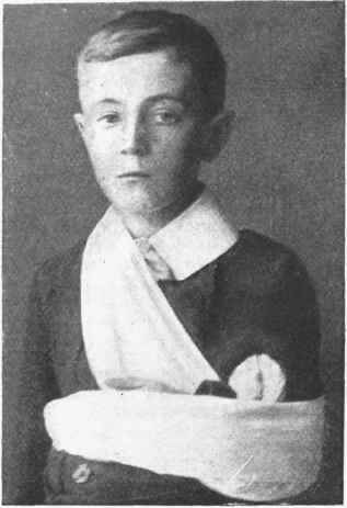 Fig. 2. For a fractured collar bone tie a narrow in a broad sling