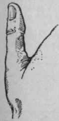 Thumb with stiff joint