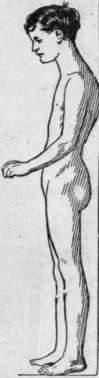 Round back isoften seen in children, and is largely the result of bad positions adopted at study