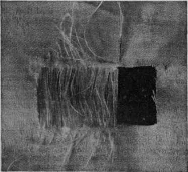 Fig. 2. The first stage in the darn after the edges of the tear have been cut square