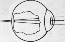 Long sight. The eye really is too short; the light rays do not meet before striking the retina