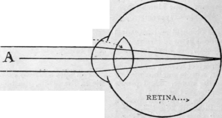 The rays of light (A) enter the eye, and are focussed on the retina by the lens