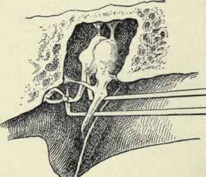 Fig. 105. Tenotomy of the tensor tympani tendon and separation of the incus from the stapes.