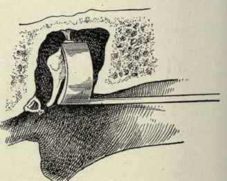 Fig. 106. Removal of the incus by means of Ludwig's hook.