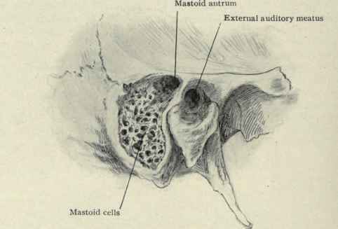 Fig. 108.   The mastoid antrum exposed by chiselling through the suprameatal triangle. The mastoid cells exposed by chiselling off the surface of the mastoid process.