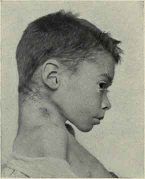 Fig. 145    Cervical caries with retropharyngeal abscess opening just posterior to the sternomastoid muscle.