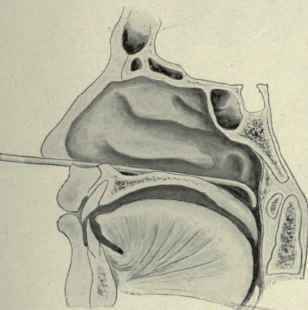 Fig. 153.   Introducing the Eustachian catheter, second step.