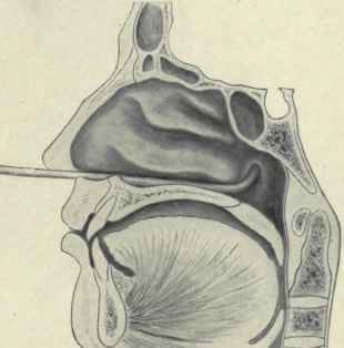 Fig. 154.   Introducing the Eustachian catheter, third step.