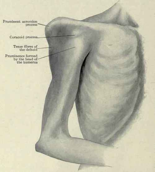 Fig. 246.   Surface view: subcoracoid dislocation of the humerus, showing the elevation of the shoulder abduction of the arm, prominence of the displaced head below the coracoid process, flattening of the shoulder, and tense fibres of the deltoid muscle.