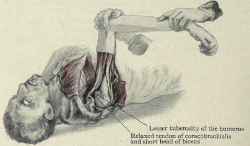 Fig. 254.   Raising the arm to a vertical line or a little more relaxes the tendon of the coracobrachialis and short head of the biceps muscle and allows the lesser tuberosity of the humerus to pass beneath it when the arm is rotated inward to place the hand on the opposite shoulder.