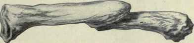 Fig. 256.   Fracture of the clavicle just outside of the middle, with the customary deformity.