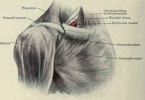 Fig. 257.   Fracture of the clavicle just outside the middle. The outer fragment is displaced downward and inward and the inner fragment upward. The brachial plexus and subclavian vessels are behind the inner end of the outer fragment.