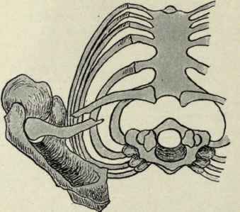 Fig. 258.   Showing how the shoulder falls inward and the posterior edge of the scapula tilts outward when the prop like action of the clavicle is destroyed by fracture.