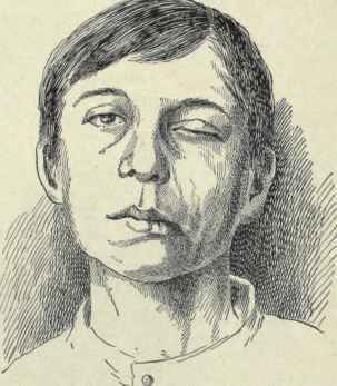 Fig. 26   Paralysis of the facial nerve from fracture of base of skull (author's case).
