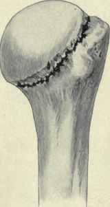 Fig. 260. Fracture through the anatomical neck of the humerus.